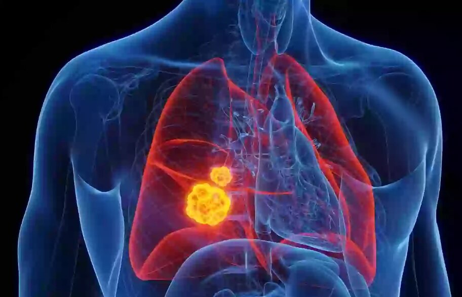این نوع از کلم مانع از ابتلا به سرطان ریه میشود این نوع از کلم مانع از ابتلا به سرطان ریه میشود